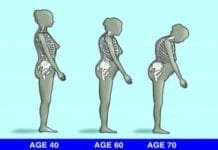 osteoporosis